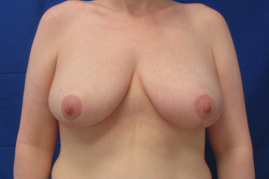 breast reduction before and after