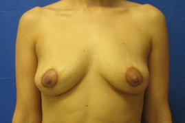 implant removal & breast lift before and after