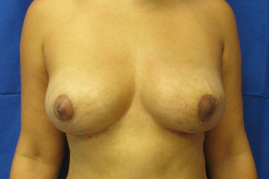 implant removal & breast lift before and after