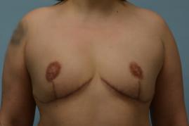 BREAST REDUCTION
