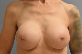BREAST RECONSTRUCTION