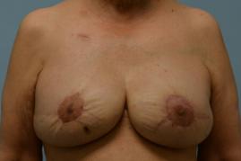 BREAST RECONSTRUCTION