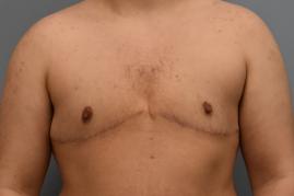 TOP SURGERY