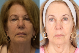 face lift before & after