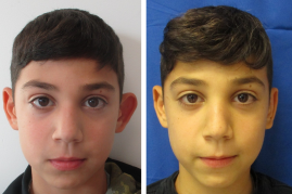 otoplasty of left ear before & after