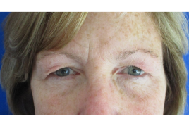 Bilateral Upper Eyelid Blepharoplasty before & after
