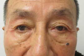 Bilateral Upper Eyelid Blepharoplasty before & after