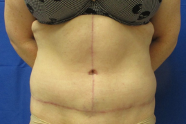 Fleur de Lis Abdominoplasty before & after