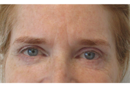Brow Lift, Bilateral Upper & Lower Blepharoplasty before & after