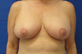 breast reduction before and after
