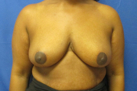 breast reduction before and after