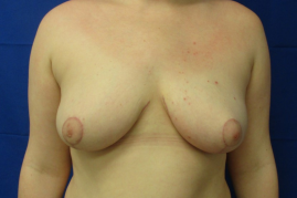 breast reduction before and after