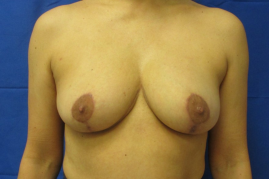 breast reduction before and after