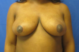 breast reduction before and after