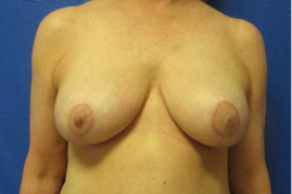 breast reduction before and after