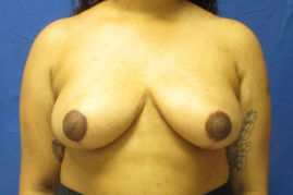 breast reduction before and after