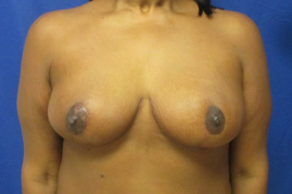 breast reduction before and after