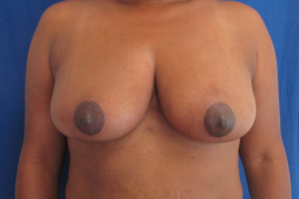 breast reduction before and after