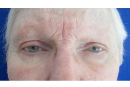 Bilateral Upper Eyelid Blepharoplasty before & after