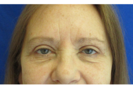 Bilateral Upper Eyelid Blepharoplasty before & after