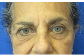 Bilateral Upper Eyelid Blepharoplasty before & after