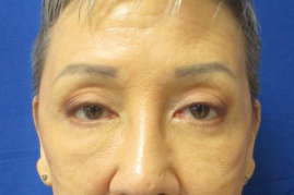 Bilateral Upper & Lower Eyelid Blepharoplasty before & after