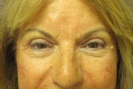 Bilateral Upper Eyelid Blepharoplasty before & after