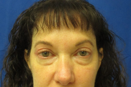 Bilateral Upper Eyelid Blepharoplasty before & after