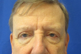 Bilateral Upper Blepharoplasty with Bilateral Ptosis Repair before & after