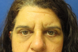 Bilateral Upper & Lower Eyelid Blepharoplasty before & after