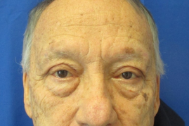 Bilateral Upper Eyelid Blepharoplasty before & after