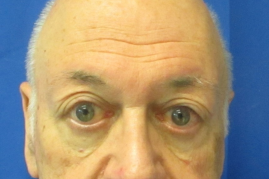 Bilateral Upper Eyelid Ptosis Repair before & after