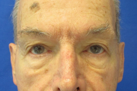 Bilateral Upper Eyelid Ptosis Repair before & after