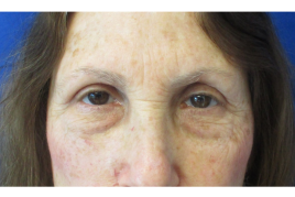 Bilateral Upper Eyelid Blepharoplasty before & after