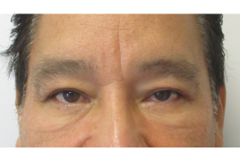 Bilateral Upper Eyelid Blepharoplasty before & after