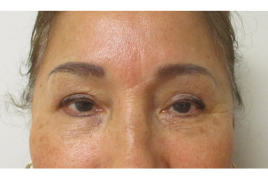 Bilateral Upper Eyelid Blepharoplasty before & after