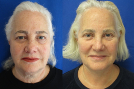 Facelift, Necklift with Bilateral Upper Bleph before & after