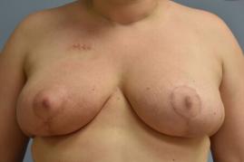 ONCOPLASTIC BREAST REDUCTION