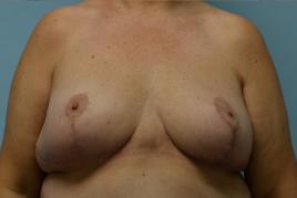 BREAST LIFT AND REMOVAL OF IMPLANTS 