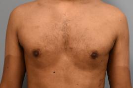 GYNECOMASTIA