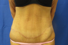 Panniculectomy before & after