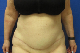 Panniculectomy before & after