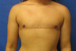 Gender affirming top surgery before & after