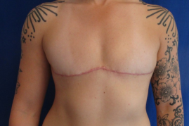 Gender affirming top surgery before & after