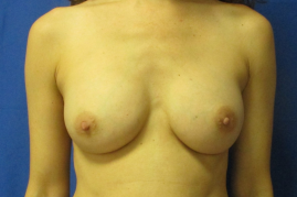 Breast augmentation before & after