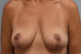 ONCOPLASTIC BREAST REDUCTION