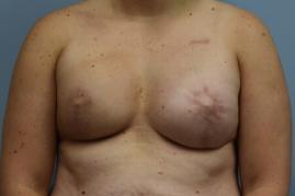 BREAST RECONSTRUCTION