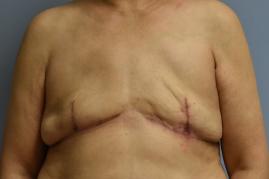 BREAST RECONSTRUCTION