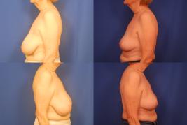 Bilateral-Breast-Reduction-G1.jpg