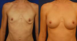Breast_implants.jpg